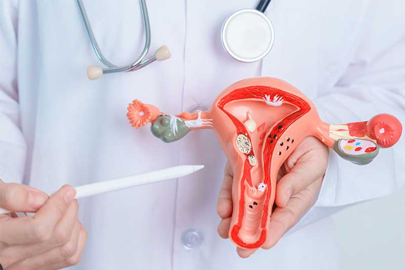 fibroids